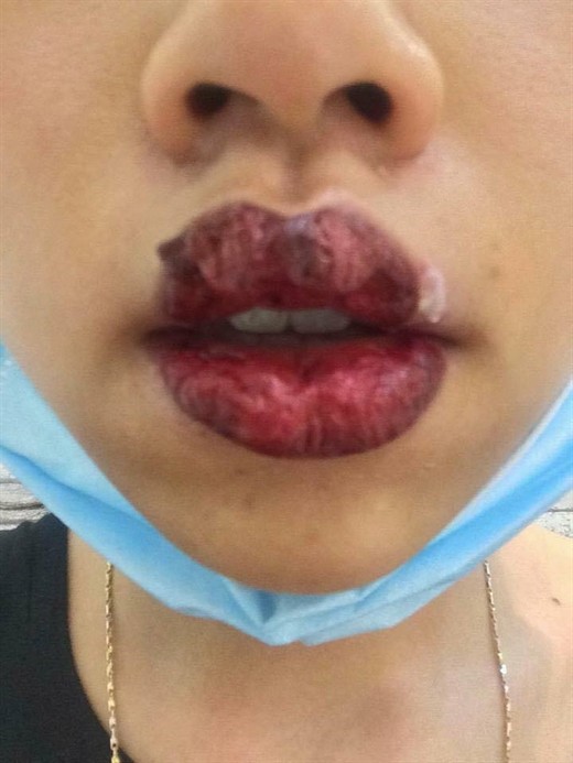 Các biến chứng khi xăm môi và cách phòng tránh