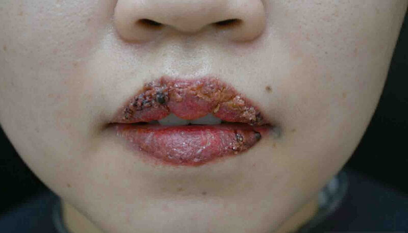 Các biến chứng khi xăm môi và cách phòng tránh