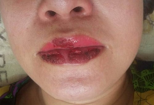 Đau đớn khi xăm môi bị sưng