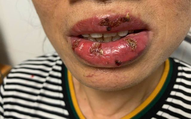 Đau đớn khi xăm môi bị sưng