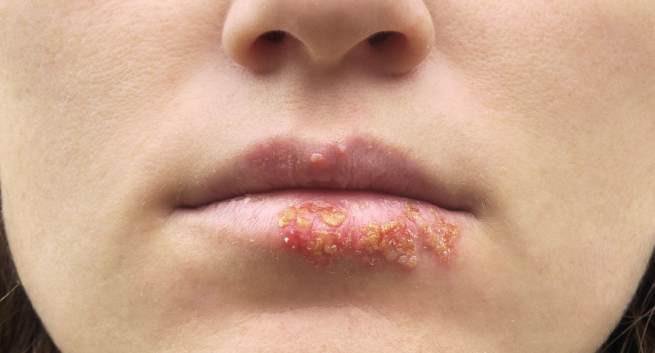 Hoảng loạn phun xăm môi mọc mụn nước