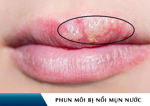 Hoảng loạn phun xăm môi mọc mụn nước