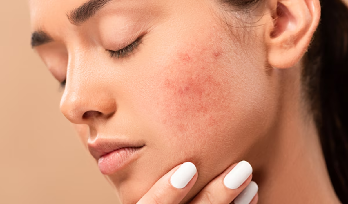 Bí Quyết Ngăn Ngừa Nám Da Tái Phát: Bạn Đã Biết Chưa?