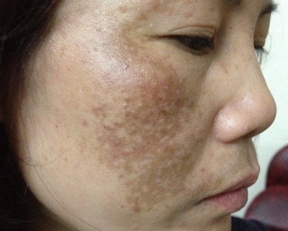 Bí Quyết Ngăn Ngừa Nám Da Tái Phát: Bạn Đã Biết Chưa?