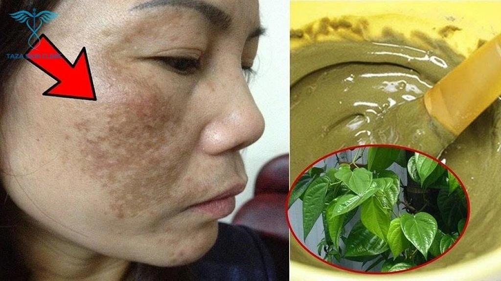 Bí Quyết Trị Nám Tự Nhiên Tại Nhà Hiệu Quả Và An Toàn