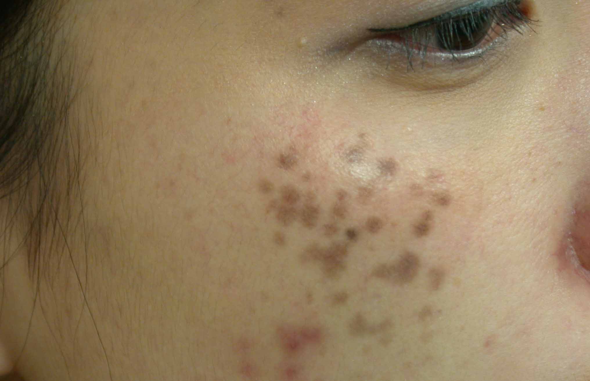 Nám Da - Kẻ Thù Số 1 Của Làn Da Đẹp: Hiểu Để Phòng Ngừa và Điều Trị