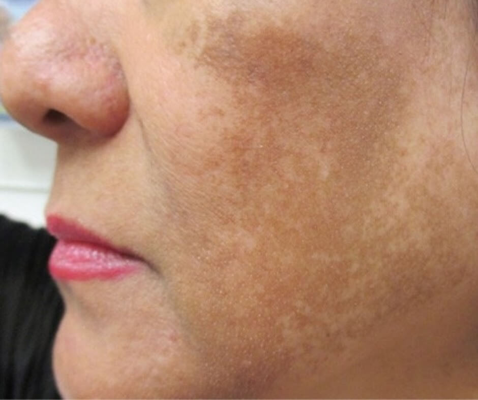 Nám Da - Kẻ Thù Số 1 Của Làn Da Đẹp: Hiểu Để Phòng Ngừa và Điều Trị