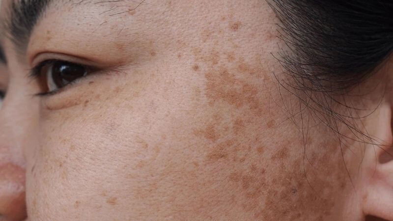 Nguyên Nhân Gây Nám Da: 5 Yếu Tố Chính và Cách Phòng Ngừa Hiệu Quả