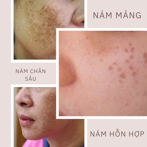 Nguyên Nhân Gây Nám Da: 5 Yếu Tố Chính và Cách Phòng Ngừa Hiệu Quả