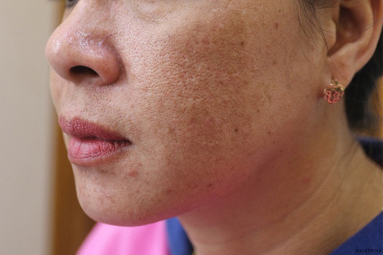 Nguyên Nhân Và Phân Loại Nám Da: Bạn Đã Hiểu Đúng Chưa?
