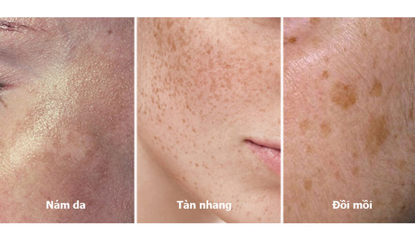 Nỗi Lo Về Nám Da: Hiểu Rõ Nguyên Nhân và Giải Pháp Hiệu Quả