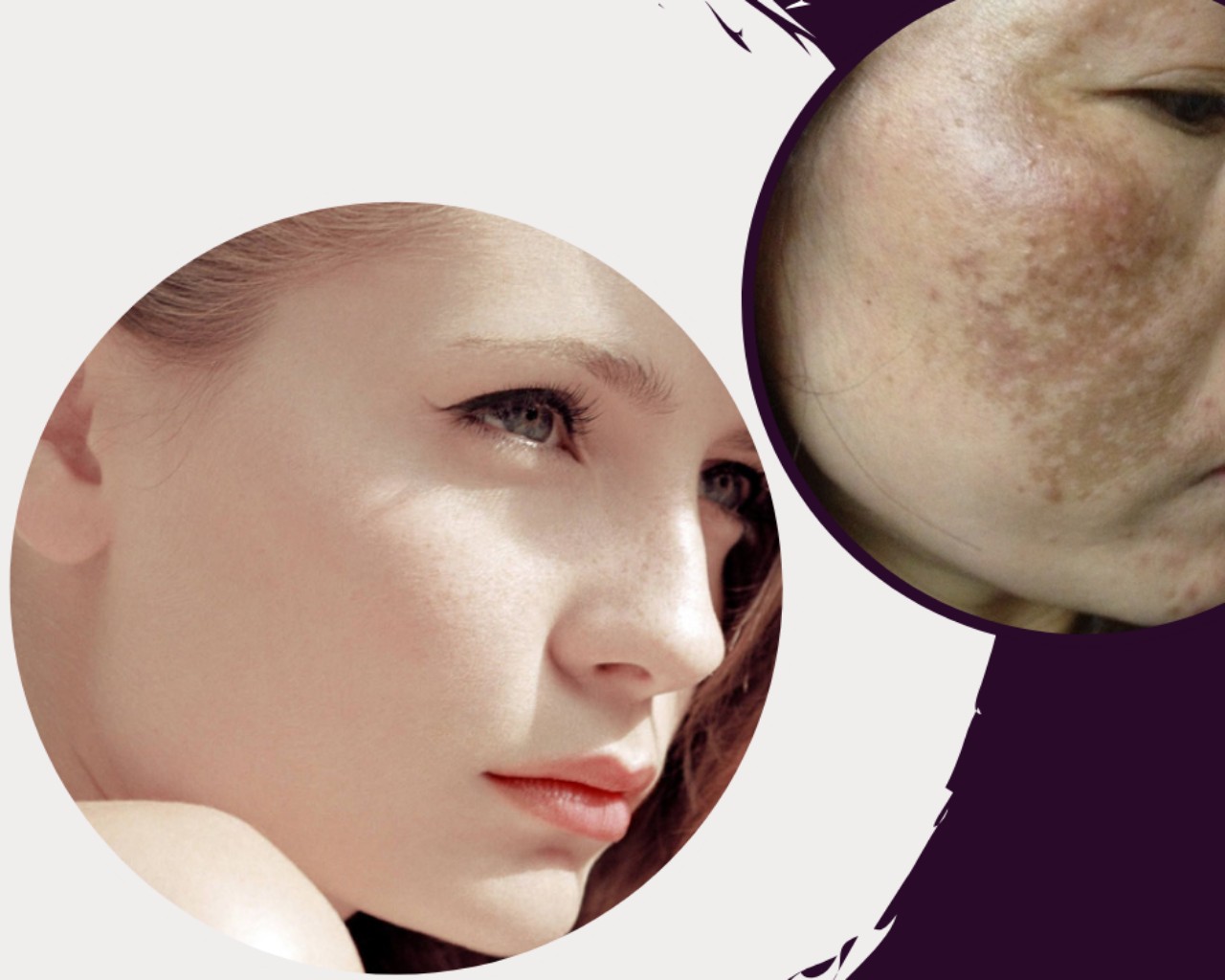 Nỗi Lo Về Nám Da: Hiểu Rõ Nguyên Nhân và Giải Pháp Hiệu Quả